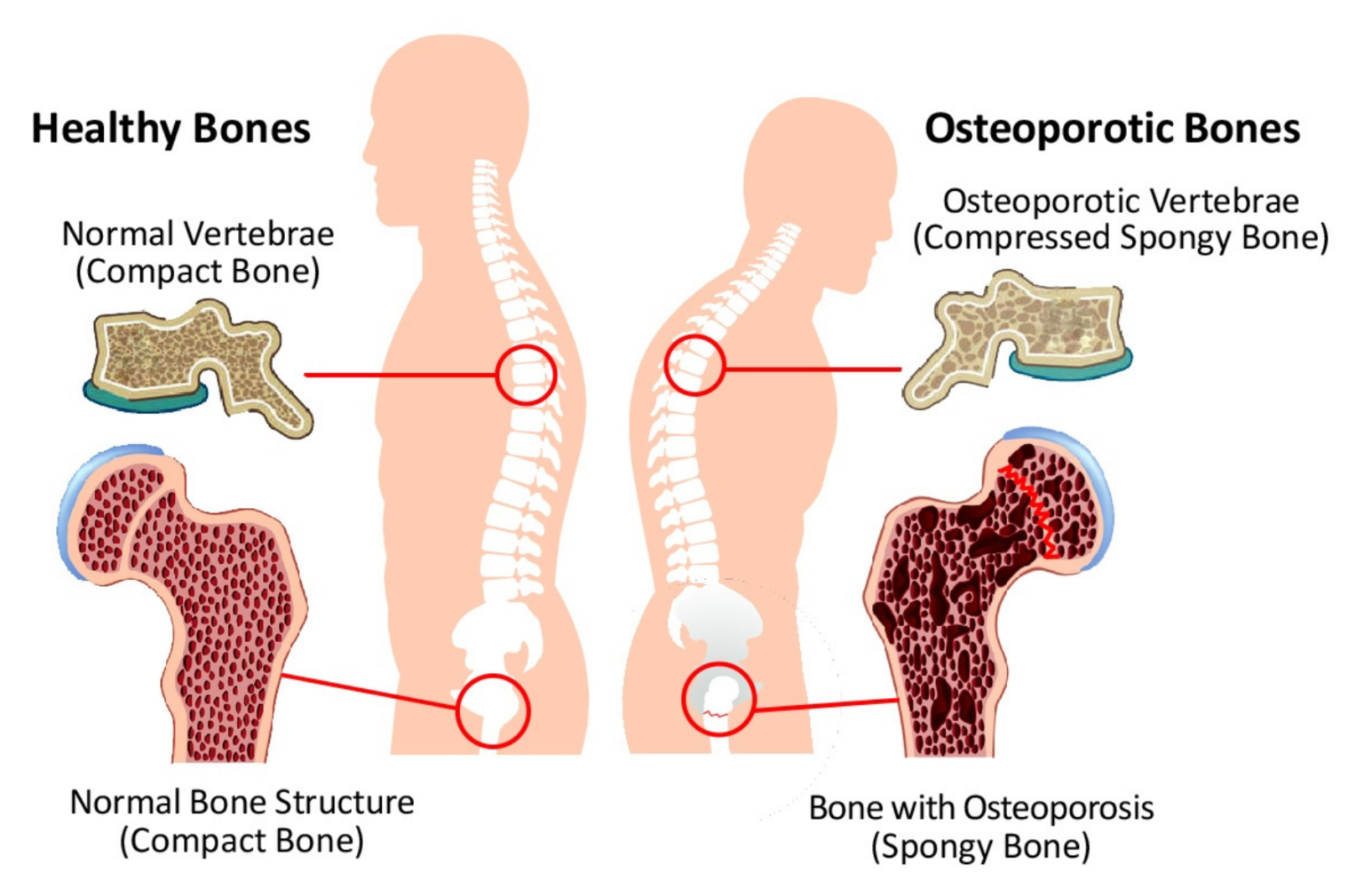 Osteoporosis Functional Medical Corporation